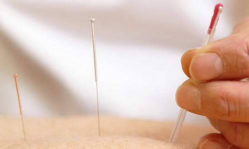 Acupuncture is available at Tavistock Physio Clinics